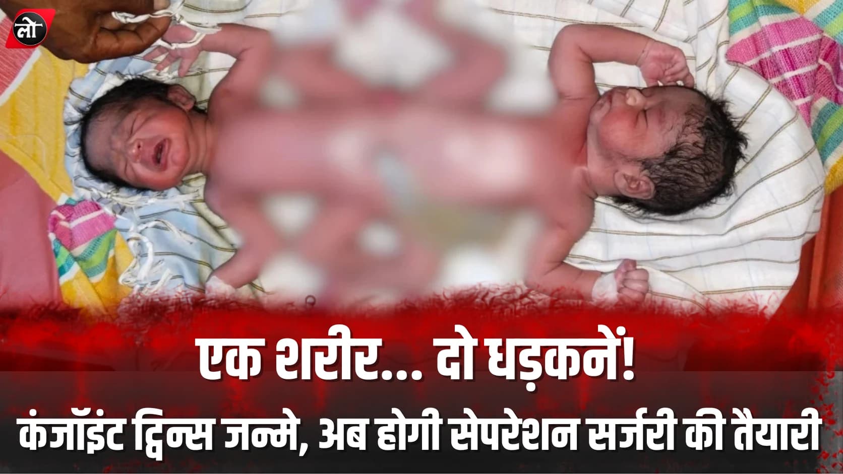 एक शरीर... दो धड़कनें! नरसिंहपुर जिला अस्पताल में जन्मे कंजॉइंट ट्विन्स, अब विशेषज्ञों के सामने सबसे बड़ी चुनौती